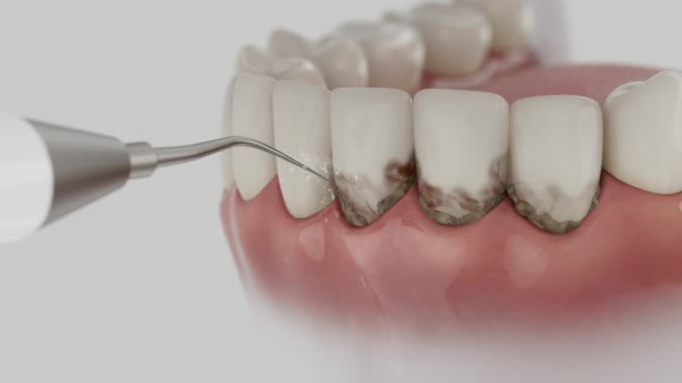 Trusted Wisdom Tooth Removal service in La Porte, IN - Dentist Open Now